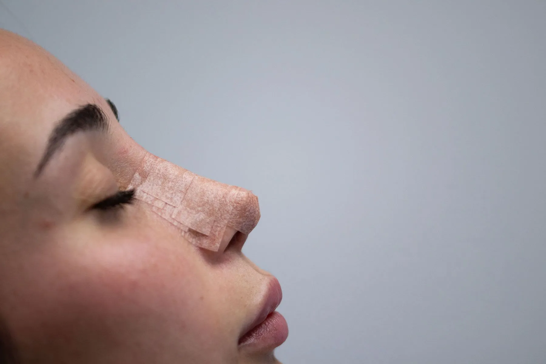 Rinoplastia primaria y de revisión