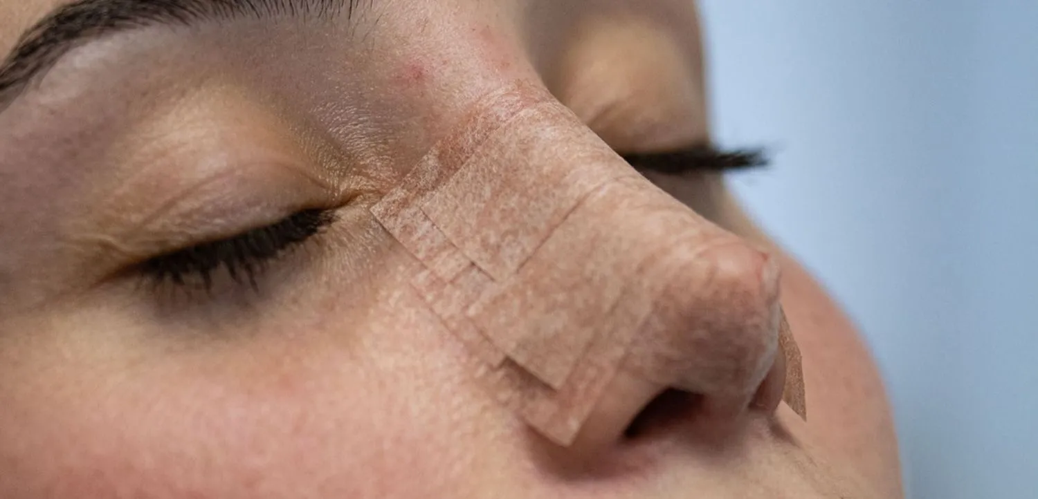 Rinoplastia de revisión
